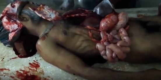 Autopsy Video – Autopsy of an ugly man