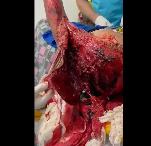Gore video – The skin on her hand was peeled off by the motorcycle accident