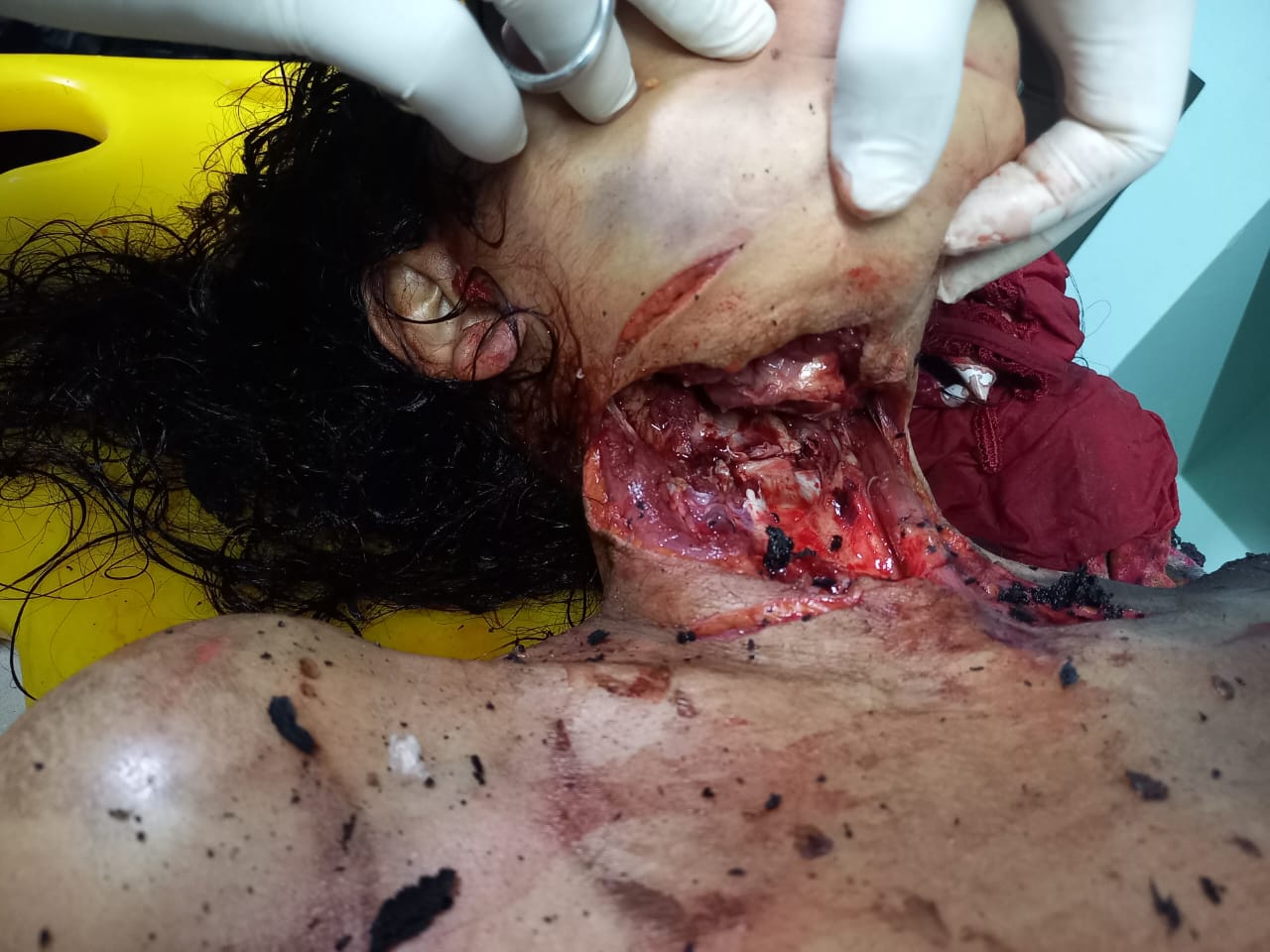 The woman had her throat cut and burned