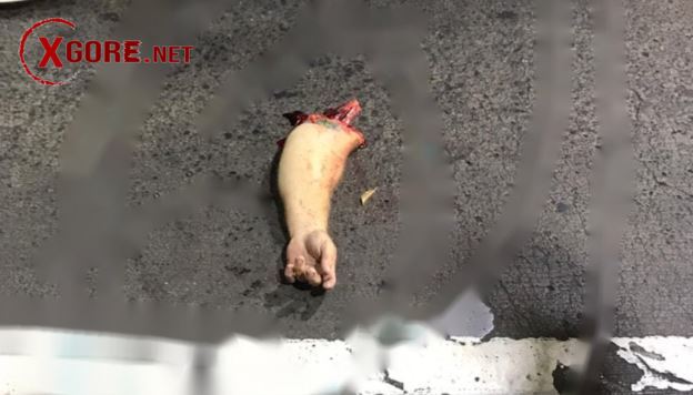 arm severed in accident